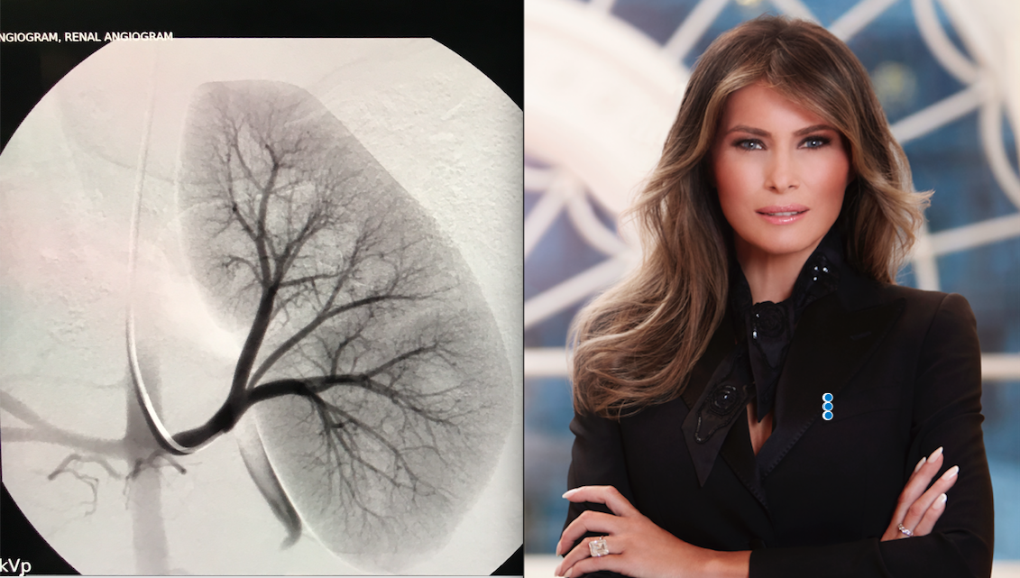 U.S. First Lady Melania Trump Undergoes Interventional Radiology